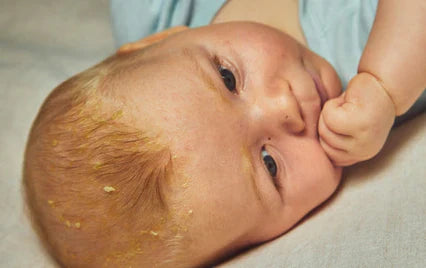 一位有頭泥問題的寶寶 - Mustela Hong Kong - 1